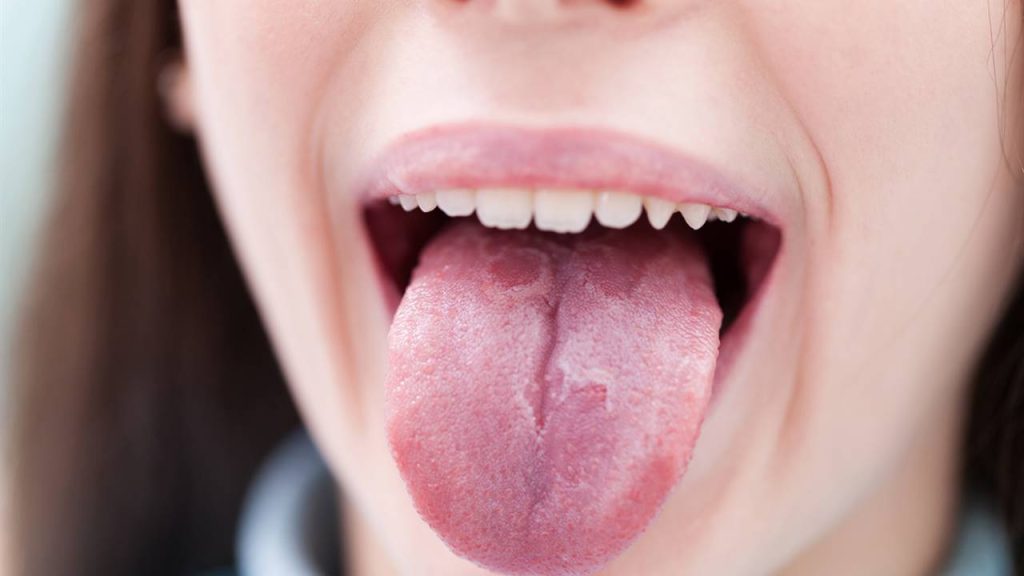 Geographic tongue treatment and causes of spots on the tongue